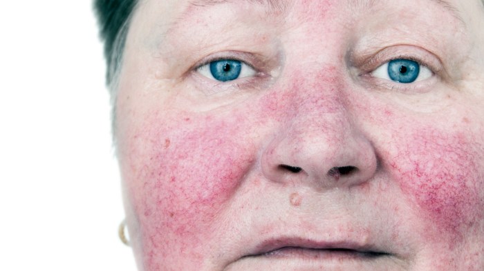 Rosacea