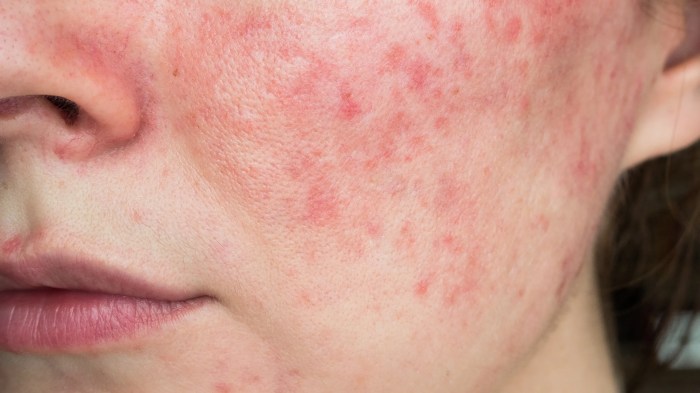 When providing services for a client with rosacea you should